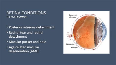 VIDEO: Demystifying Retinal Diseases - UCSD-TV - University of ...