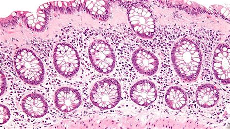 How well do you know Microscopic Colitis