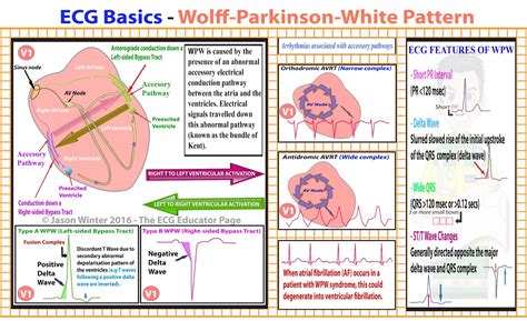 ECG Educator Blog : Wolff-Parkinson-White