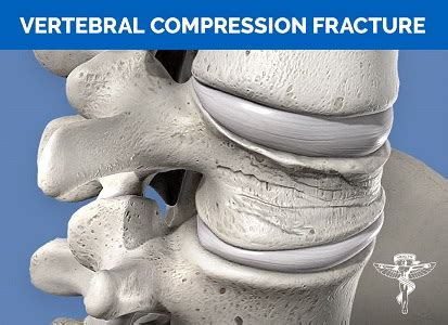 Compression Fracture | Chiropractor Cairns Ph: 4031 0480