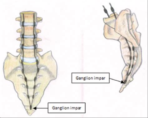 Impar Ganglion Block with Combination of Neurolysis Drugs and Radiofrequency Thermocoagulation ...