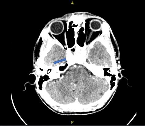 Cureus | Atypical Cavernous Sinus Thrombosis: A Diagnosis Challenge and ...