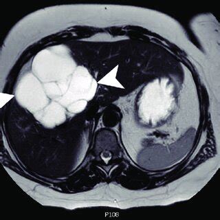 An axial slice from a T2 weighted MRI scan with Eovist contrast. A... | Download Scientific Diagram