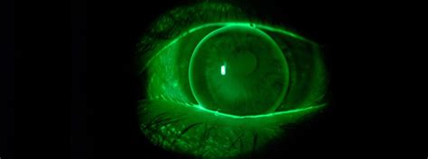 What Is a Corneal Abrasion? - Optometrists.org