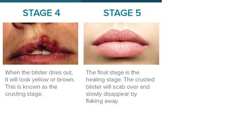 Cold Sore Stages: Identification and Treatment