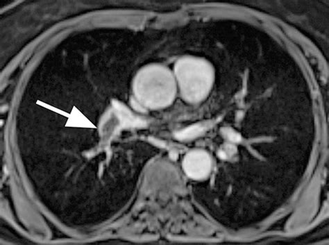 MR Imaging of Pulmonary Embolism: Diagnostic Accuracy of Contrast ...