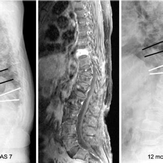 (PDF) The Diagnosis of Osteoporotic Occult Vertebral Fracture and ...