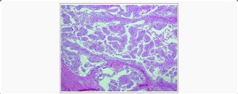 Papillary thyroid carcinoma. Papillae with ground glass (Orphan Annie ...