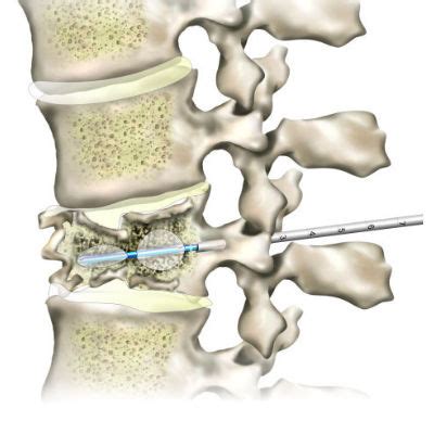 Understanding the Balloon Kyphoplasty Procedure - Spine Center Miami