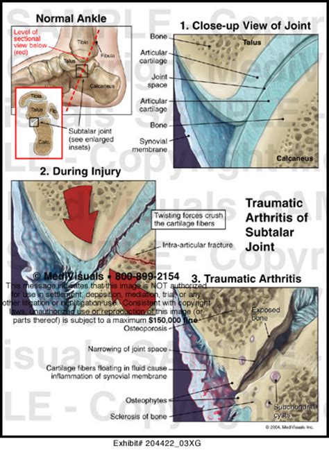 Traumatic Arthritis of Subtalar Joint Medical Illustration Medivisuals