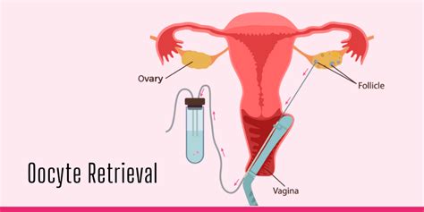 Oocyte Retrieval: What one should know? | Nisha IVF Centre