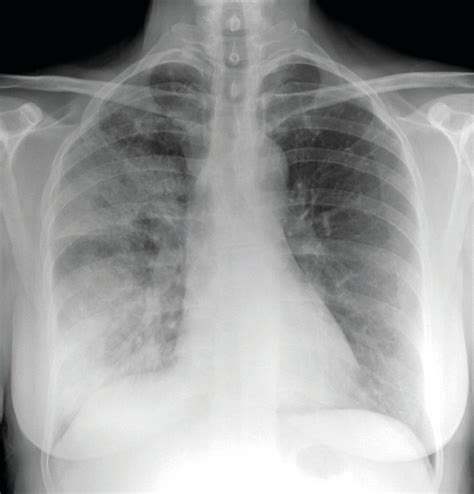 Death rates from community acquired pneumonia falling in NHS hospitals | Nursing Times