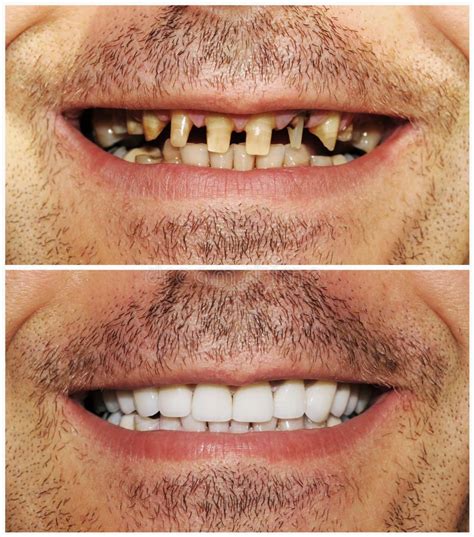 Before and after. Picture of heathy and bad teeth #Sponsored , #ad, #paid, #Picture, #bad, # ...