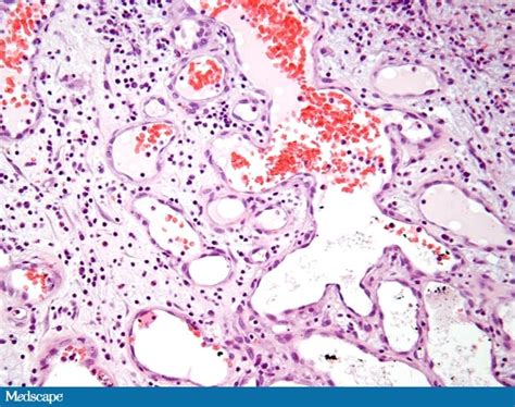 Pyogenic Granuloma Histopathology