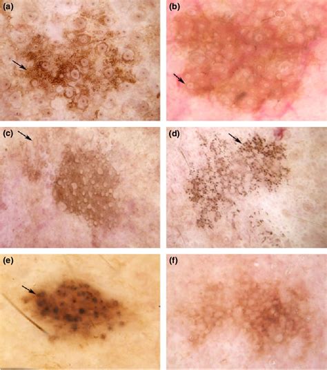 Figure 2 from Dermatoscopy of flat pigmented facial lesions. | Semantic Scholar