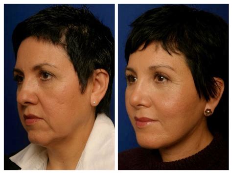 Medical Treatment Pictures-for Better Understanding: Chin Lift Surgery: Before & After Chin lift