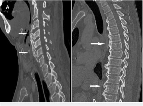 Preoperative sagittal cervical and thoracic computed tomography (CT ...