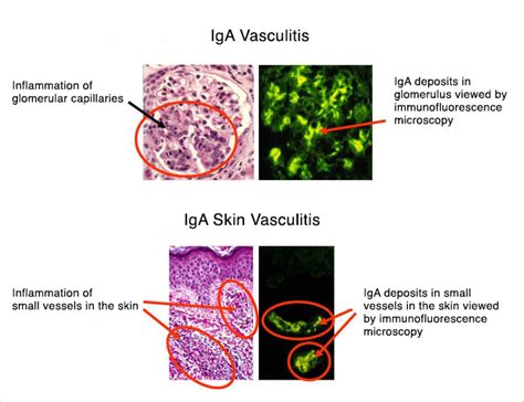 Henoch Schonlein Purpura In Adults