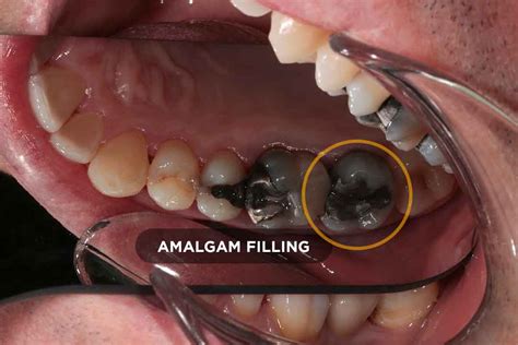 The Treacherous Amalgam Filling - Dental Studio