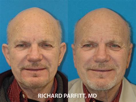 Ear Surgery Otoplasty Photos - Dr. Richard Parfitt