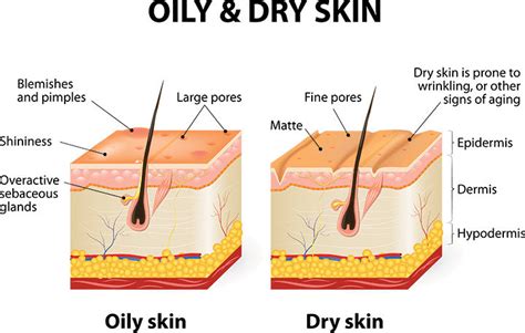 Oily Skin - Causes, Prevention And Treatments – SkinKraft