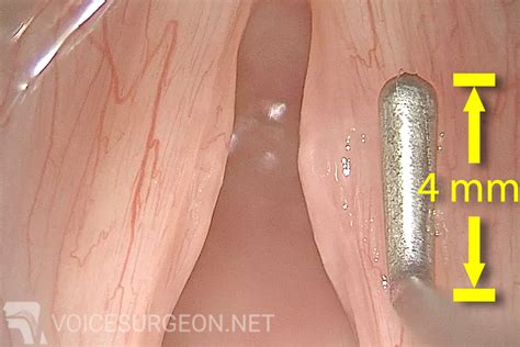 Vocal Cord Nodules - Vocal Cord Nodules Cancer Surgery - Voice Surgeon