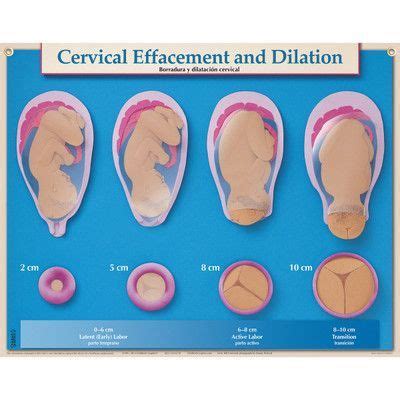 Cervix Dilation Chart Labor