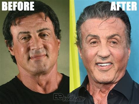 Plastic Surgery Gone Wrong 31 Worst Celebrity Before And After