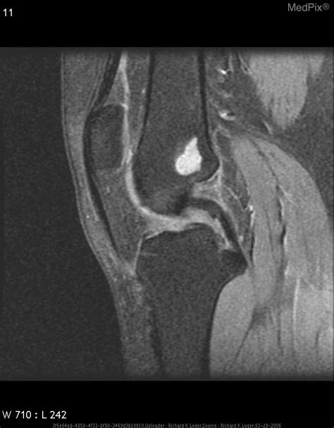 Enchondroma Mri