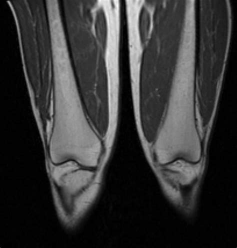 Erlenmeyer flask deformity - wikidoc