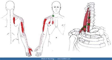 Myofascial pain syndrome | MedLink Neurology