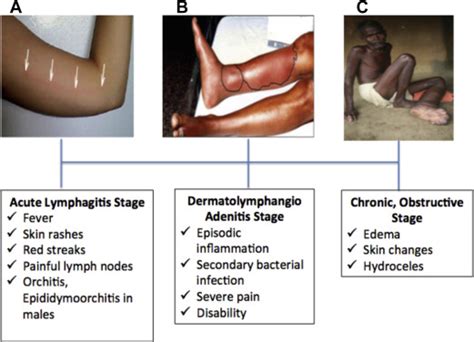 Lymphatic Filariasis - Nursing Clinics