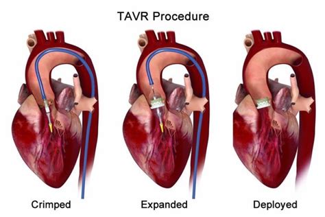 TAVR - Transcatheter Aortic Valve Replacement | Dr. Tejas V. Patel | Cardiologist