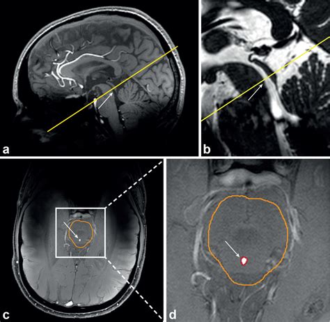 Cerebral Aqueduct Mri