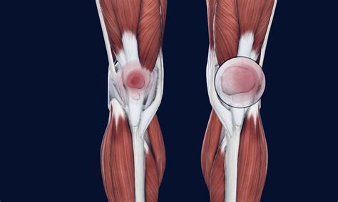 Patellofemoral Syndrome - Osteo Health – osteopath clinic in Calgary