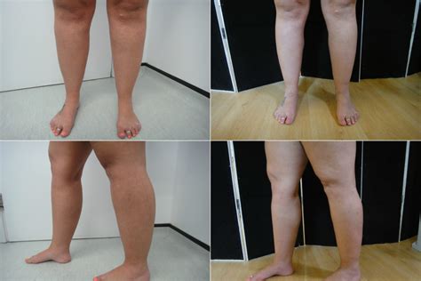 patient1-before-after-lipo-cankles-lipoedema-calves-microlipo - Dr Puneet Gupta - Breast ...