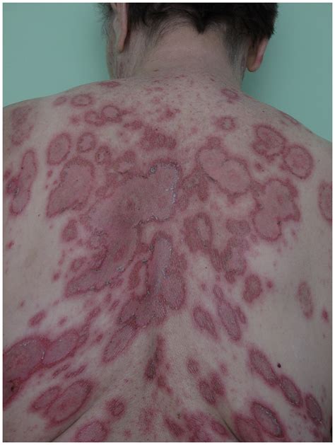 Subacute Cutaneous Lupus