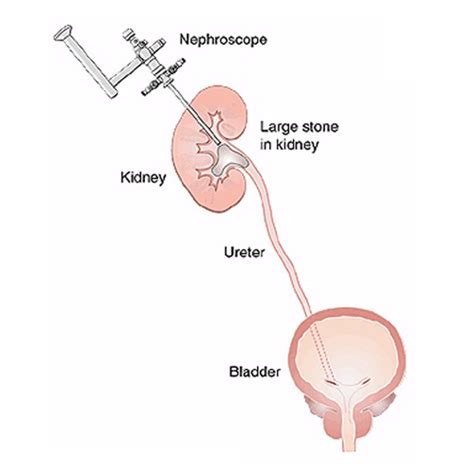 Mini-Percutaneous Nephrolithotomy - Advin Urology