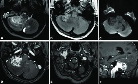 Magnetic resonance imaging of a glomus jugulare paraganglioma in a... | Download Scientific Diagram