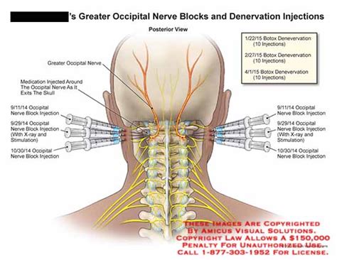 Greater Occipital Nerve Blocks and Denervation Injections