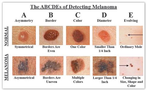 Is It Cancer? Know Your Skin Cancer ABCs. It Might Save Your Life