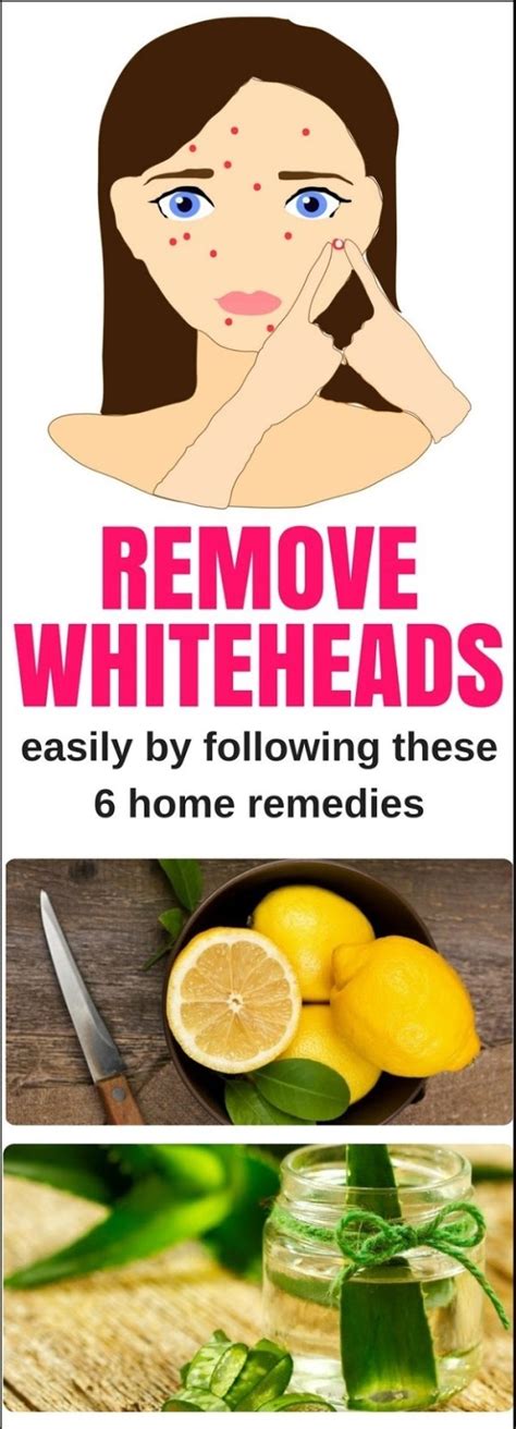 Remove Whiteheads Easily By Following These 6 Home Remedies!!!