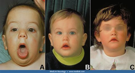 Joubert syndrome | MedLink Neurology