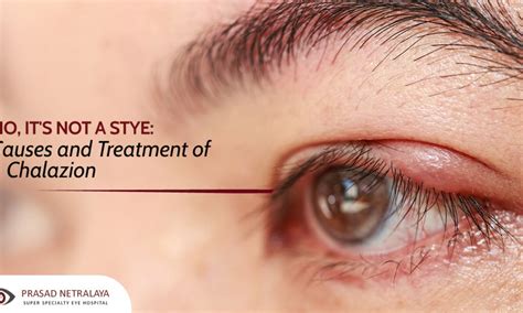 Lump On Eyelid Treatment