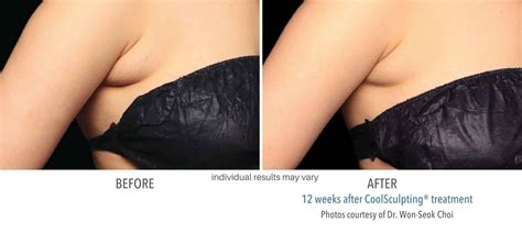 CoolSculpting Elite Before & After Progress Pictures