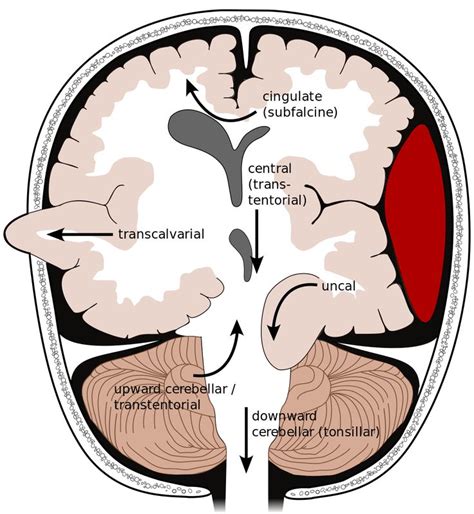 File:Brain herniation types-2.svg | Neurology, Medical knowledge, Medical anatomy