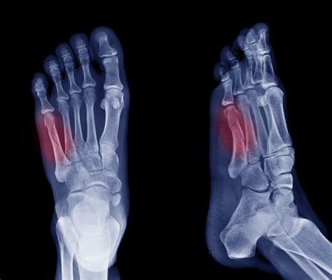 Fifth Metatarsal or Jones Fracture