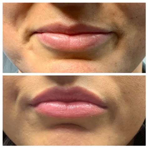 Botox Lip Flip: Everything You Need to Know | Find A Better You