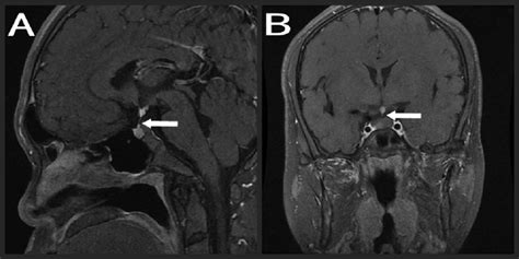 Pituitary MRI of case 2 A. sagittal view, arrow: very thin pituitary ...