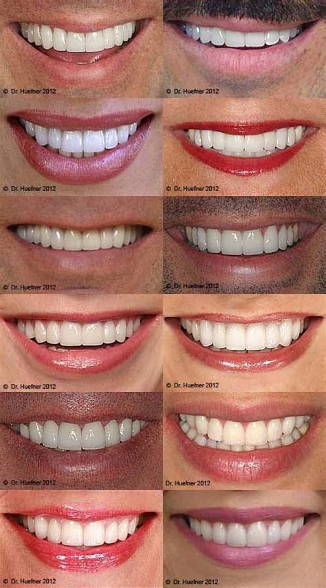 porcelain veneers orange county shapes #designcosmeticdentistry | Veneers teeth, Perfect teeth ...